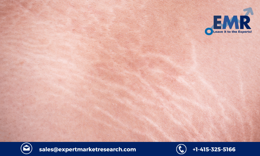 Stretch Marks Treatment Market