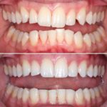 invisalign before and after