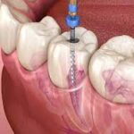 root canal near me in Houston, TX 77027